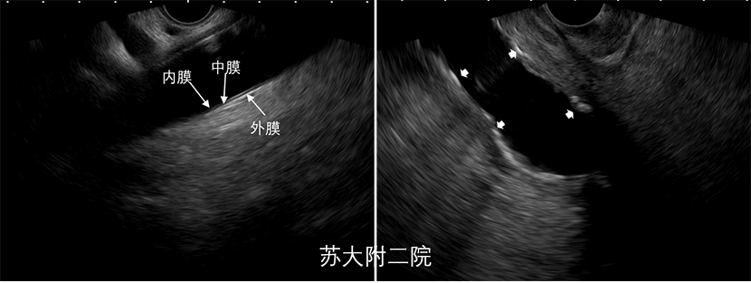 图12腹主动脉钙化.png