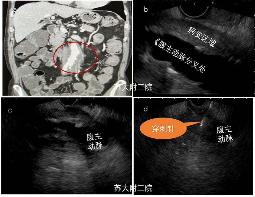 图16 腹膜后纤维化.png